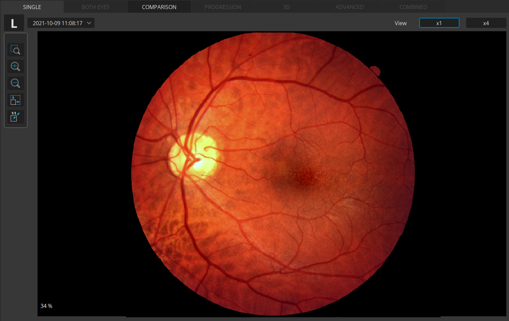 Affichage de la photo du fond d'œil en plein écran vue simple 